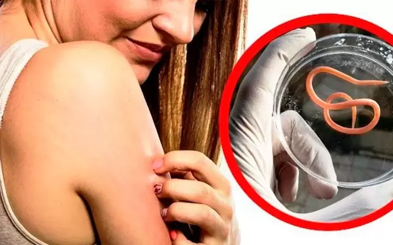 gatal dan iritasi akibat parasit di dalam tubuh