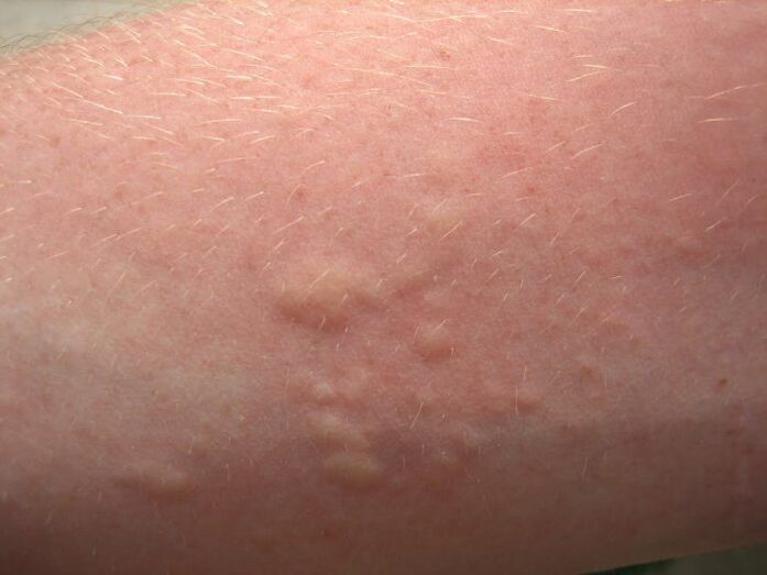 Ruam kulit alergi yang gatal bisa menjadi gejala ascariasis